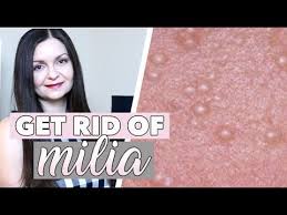 (seek an expert's assistance immediately when you spot one on your skin.) How To Get Rid Of Milia Hard White Bumps On Face Milia Around Eyes Youtube