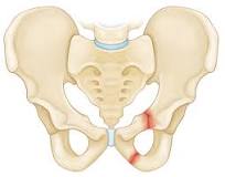 Image result for icd 10 code for multiple pubic rami fracture