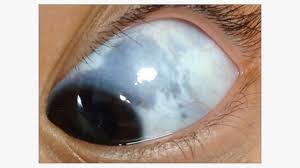 gray spot in your eye what it could mean