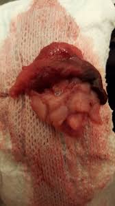 The endometrium is the mucous membrane lining the uterus. This Came Out Of Me I M Scared Graphic Image Warning Mumsnet