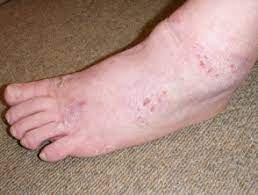 Heat rash occurs when kids get too hot. Shoe Contact Dermatitis Dermnet Nz
