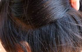 how to remove lice eggs from the hair