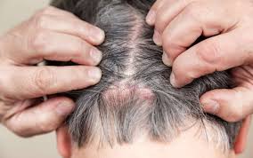 scab on the scalp causes and treatments
