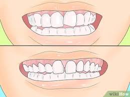 How to know if you need your wisdom teeth removed although a third set of molars were helpful for our prehistoric ancestors, many modern humans don't have enough room in their jaws to. How To Persuade Your Parents To Let You Get Braces 9 Steps