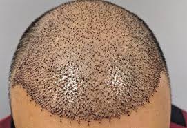 hair transplant scabs how to make them