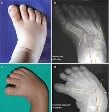 Osteoarthritis isn't the only thing that causes a bone spur on top of the foot. Common Foot Problems In Children Foot And Ankle