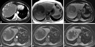 Imaging clues that can be used to narrow the differential diagnosis are discussed below. An Unusual Liver Mass Primary Malignant Mesothelioma Of The Liver Springerlink