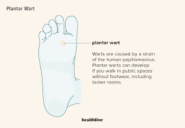 plantar wart what is it symptoms