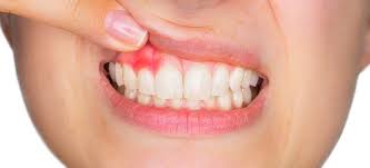 receding gums causes symptoms and