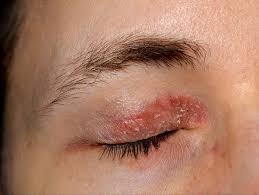 eczema around your eyes what to know