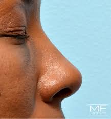 your nose appear smaller with filler