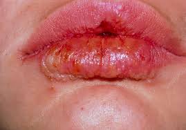 lips infected by the herpes simplex