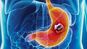Image result for stomach cancer