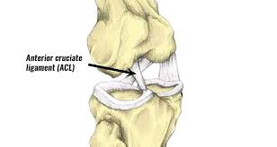 Bruising around the knee, especially around the location of the mcl (inner knee). Acl Tear Anterior Cruciate Ligament Sprain Diagnosis Rehabilitation
