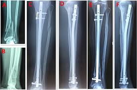 distal tibia fractures