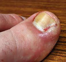 how do i use vicks for toenail fungus