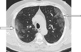 Ct Chest Findings In Patients Infected