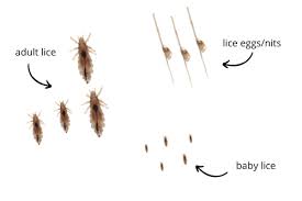 vinegar kill lice or loosen nits