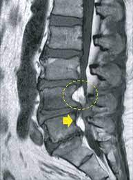 spinal epidural lipoma on the ventral