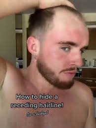 hide receding hairline