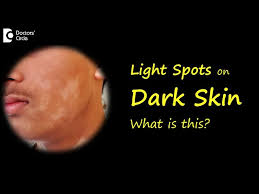 light spots patches on brown or dark