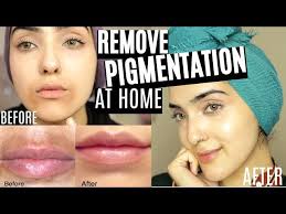 how to remove pigmentation dark spots