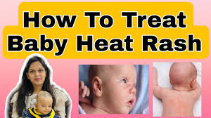 baby heat rashes natural home remes