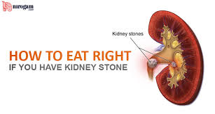 Indian Diet For Kidney Stone How To Eat Right If You Have