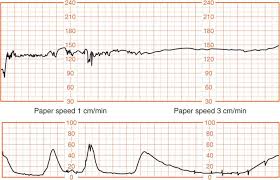 intrapartum fetal heart rate sment