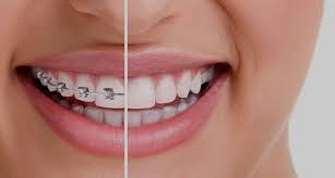 Orthodontist In Portland Or Braces Orthodontic Treatment