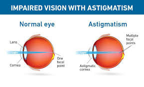 correcting astigmatism during cataract