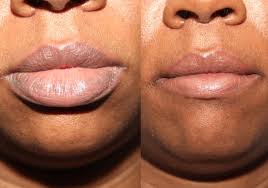 lip reduction lip augmentation in