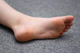 plantar warts symptoms causes