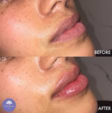 lip fillers without fear or hle