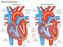 If your doctor finds out that you have the signs and symptoms of a heart defect and if he or she hears a murmur in your heart with a stethoscope, various tests will be requested Atrial Septal Defect Asd Explained