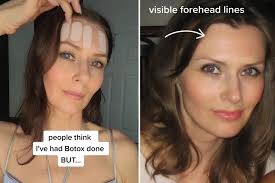 I'm 46 and reversed my forehead wrinkles without Botox