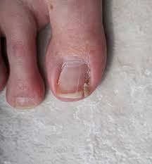 ed toenail foot specialist