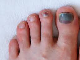 black toenail falling off causes