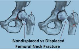 hip fractures intertrochanteric