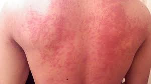Stress and anxiety are not entirely different conditions. Is It Hives Or Psoriasis Learn The Signs