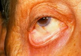 pale eyelid due to myelodysplastic