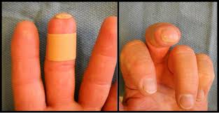 disorders of the nail orthopaedia