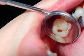 wisdom teeth facts you may not know