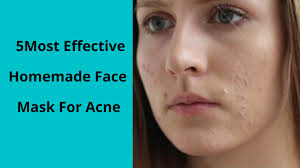 effective homemade face mask for acne