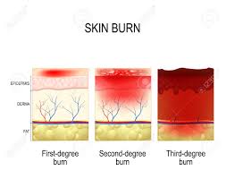 Degree Of Burns On Skin Get Rid Of Wiring Diagram Problem