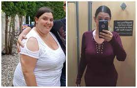 bariatric surgery helps overcome pcos