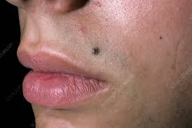 mole on upper lip stock image c054