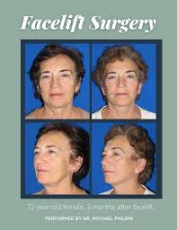 your 4 week facelift recovery guide