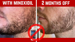 stopped minoxidil for beard growth