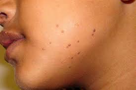 best warts removal treatment clinic